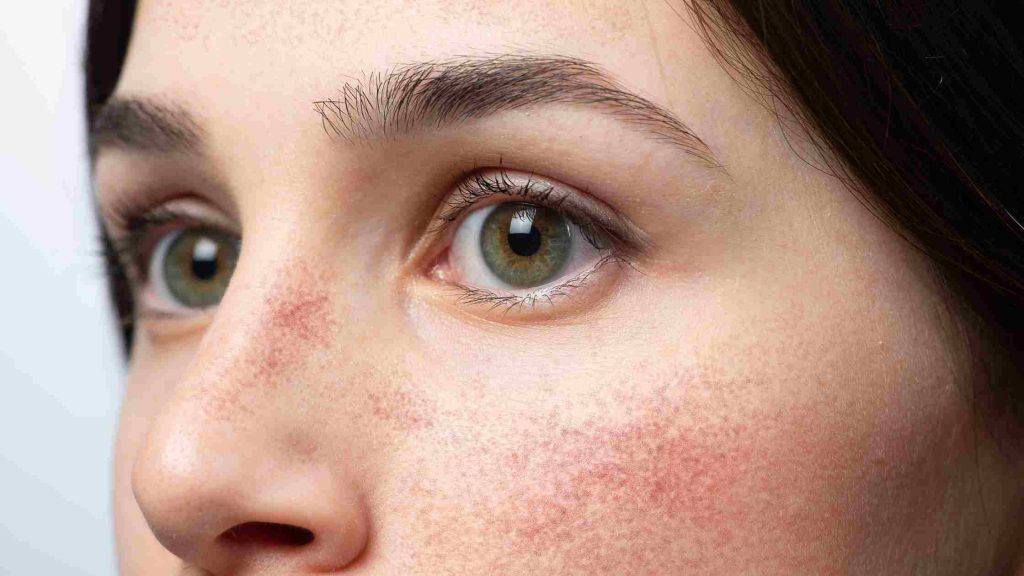 Close-up of a woman's face showing facial redness and flushing across nose and cheeks after alcohol consumption.