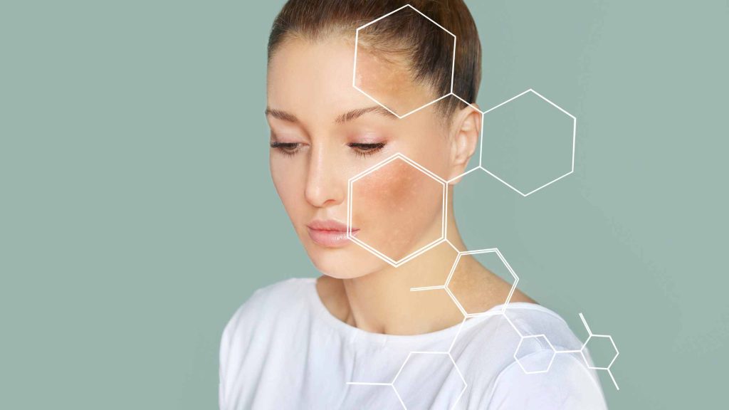 Woman with facial flushing and pigmentation, overlaid with hexagon graphics, illustrating alcohol-related skin health risks.