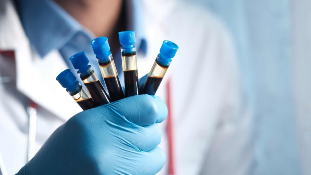 Doctor holding blood samples in test tubes, symbolizing medical evaluation and diagnosis for alcohol-related health issues.